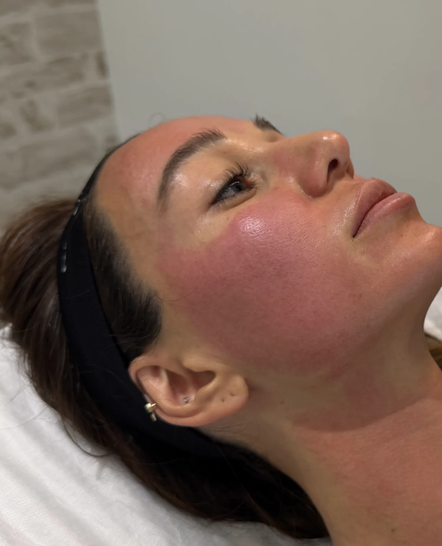 Close view of a real patient’s skin during a VAMP with microneedling session at Tate Aesthetics LA