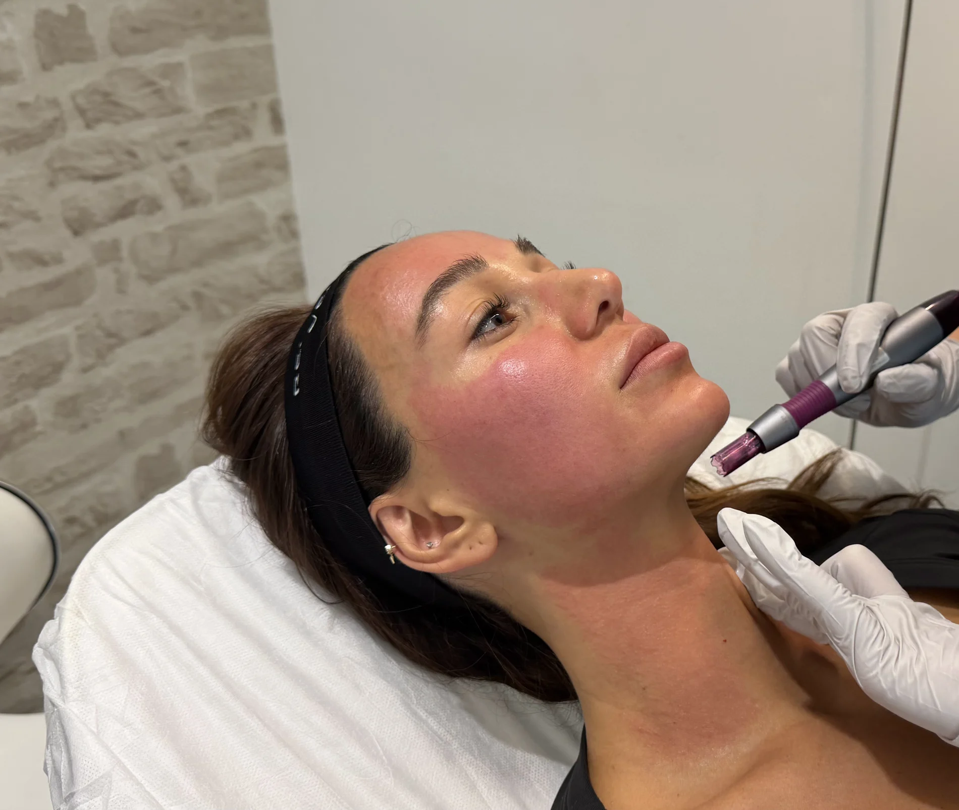 Close-up of a real patient during a VAMP with microneedling session at Tate Aesthetics LA in Sherman Oaks