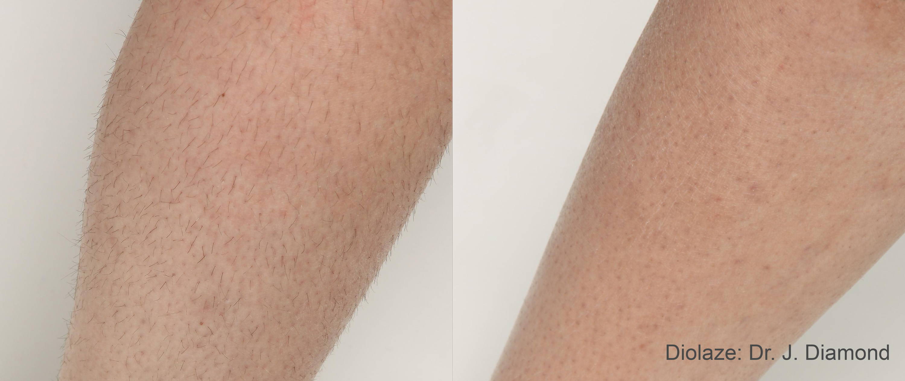 Manufacturer-published Diolaze leg before and after result