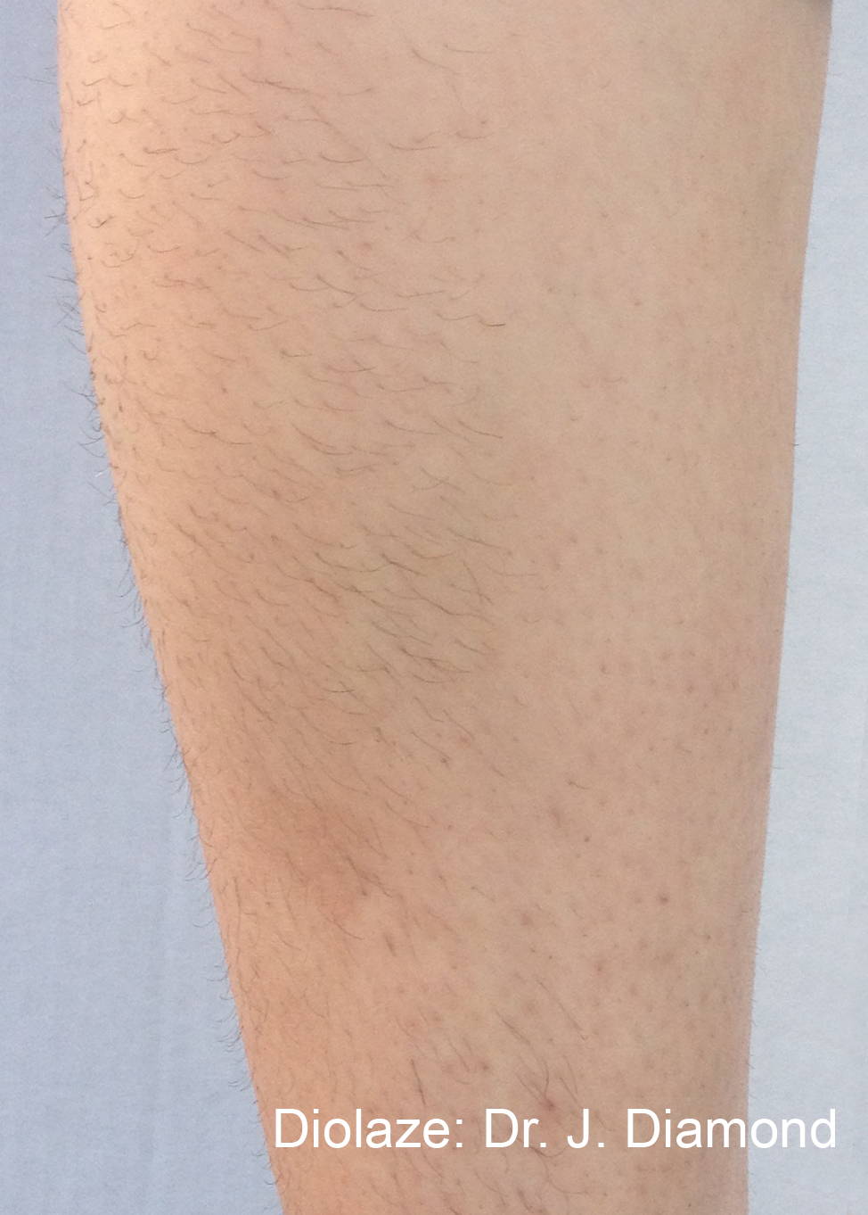 Manufacturer-published Diolaze lower leg before and after result