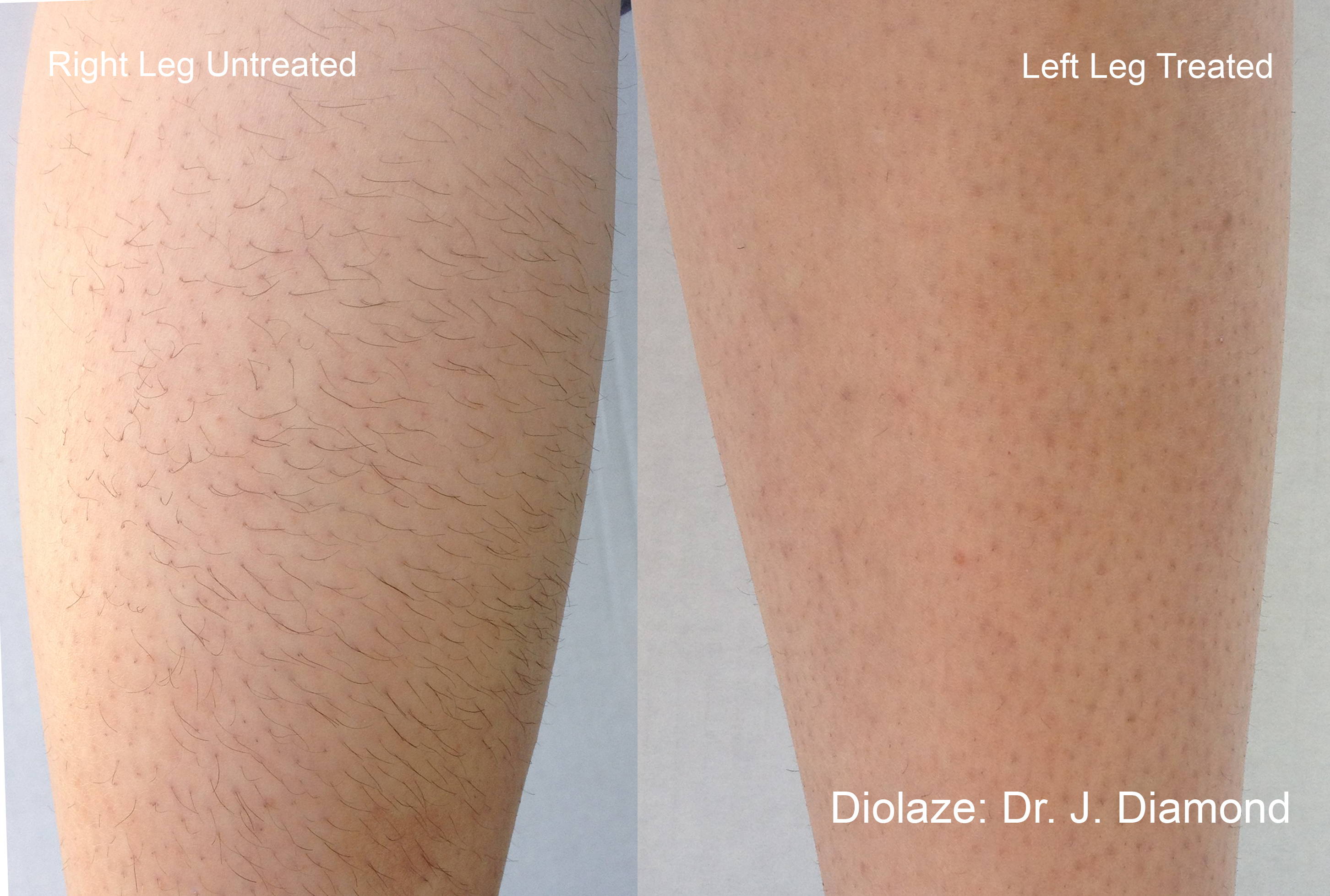Additional manufacturer-published Diolaze leg before and after result