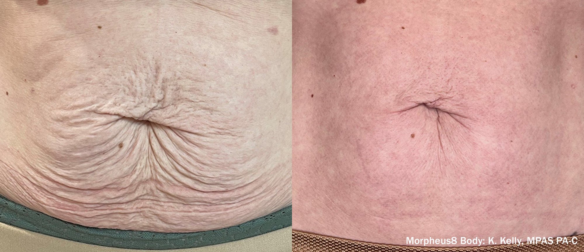 Published Morpheus8 Body before and after photographs of abdominal skin, credited to K. Kelly, MPAS PA-C
