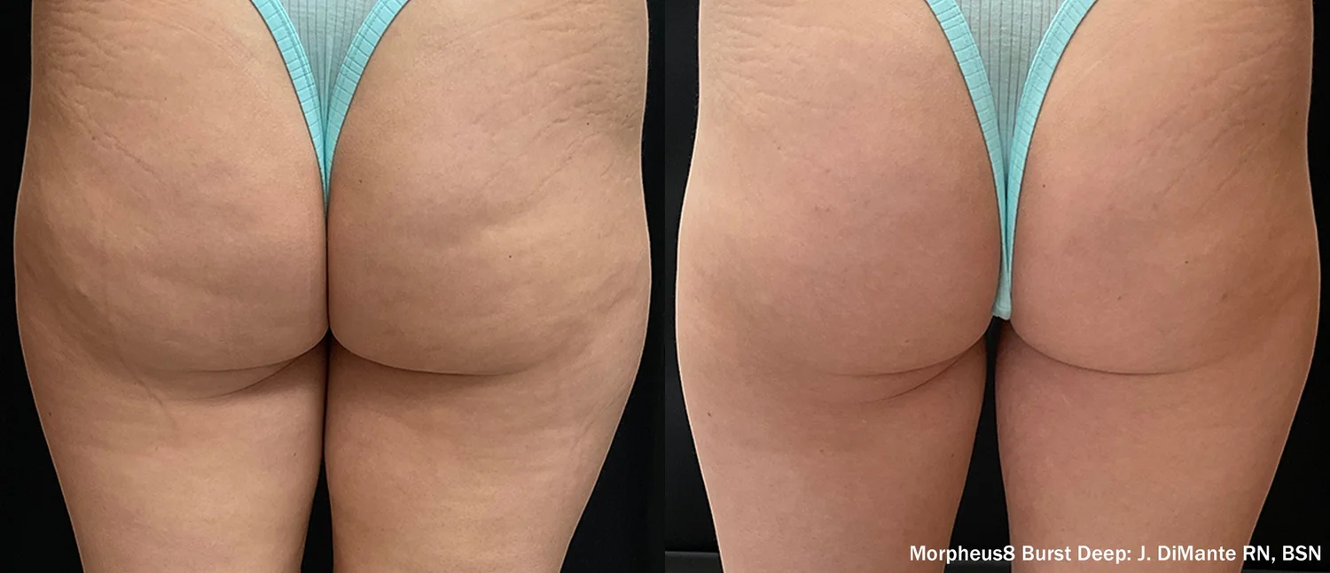 Published Morpheus8 Burst Deep before and after photographs of the buttocks, credited to J. DiMante, RN, BSN