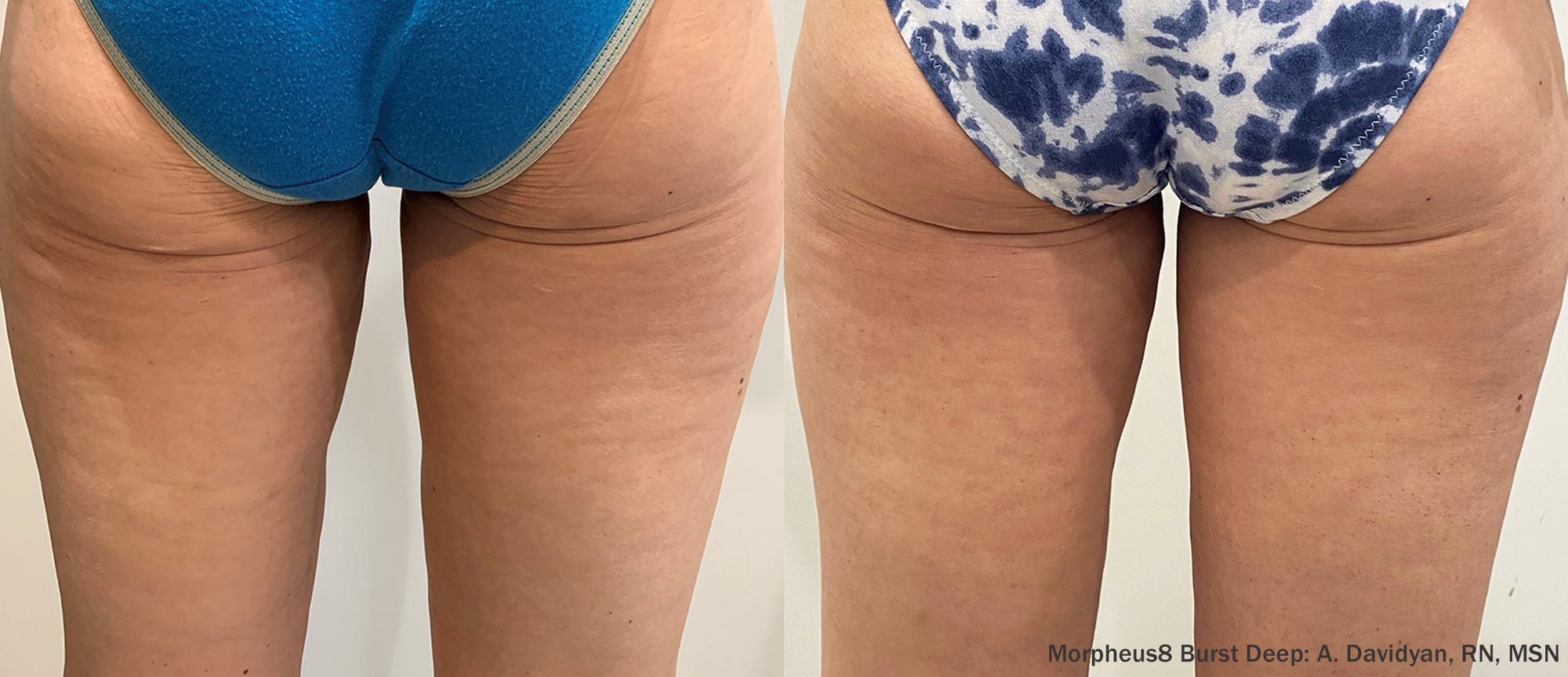 Published Morpheus8 Burst Deep before and after photographs of the buttocks and upper thighs, credited to A. Davidyan, RN, MSN