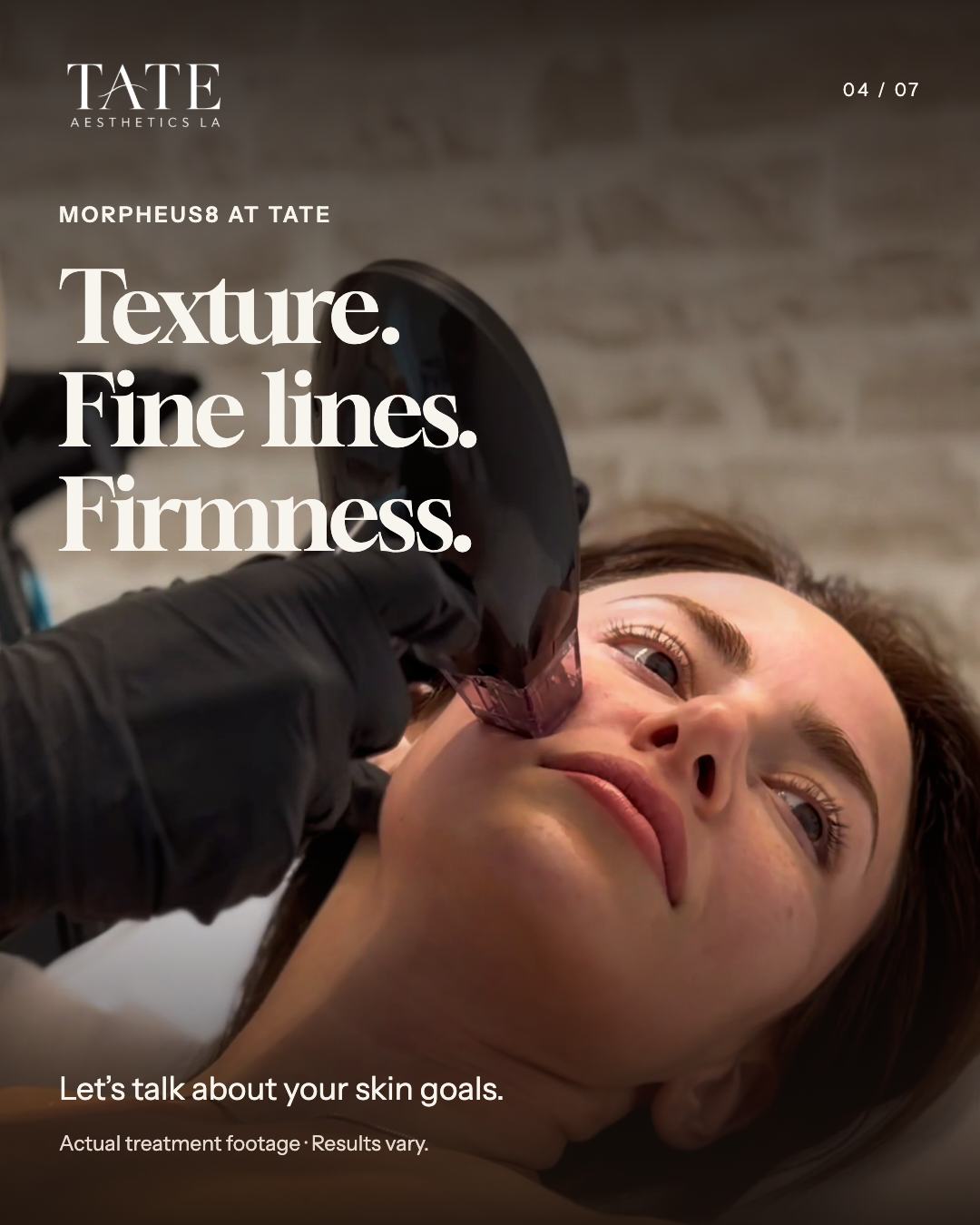 Morpheus8 treatment at Tate Aesthetics highlighting texture, fine lines, and firmness