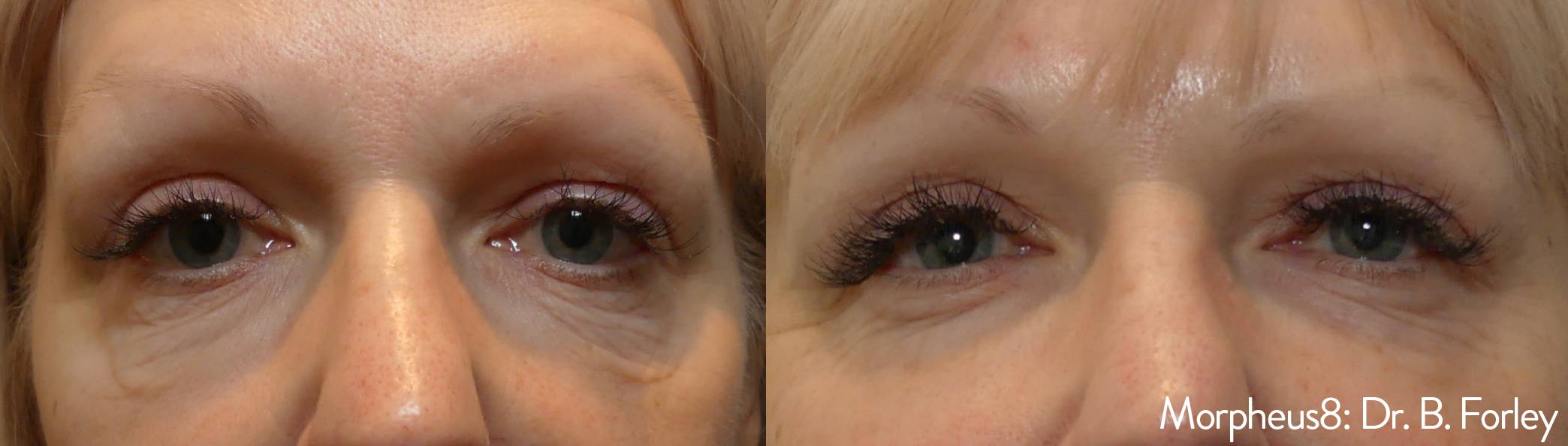 Manufacturer-published before and after Morpheus8 result around the eyes