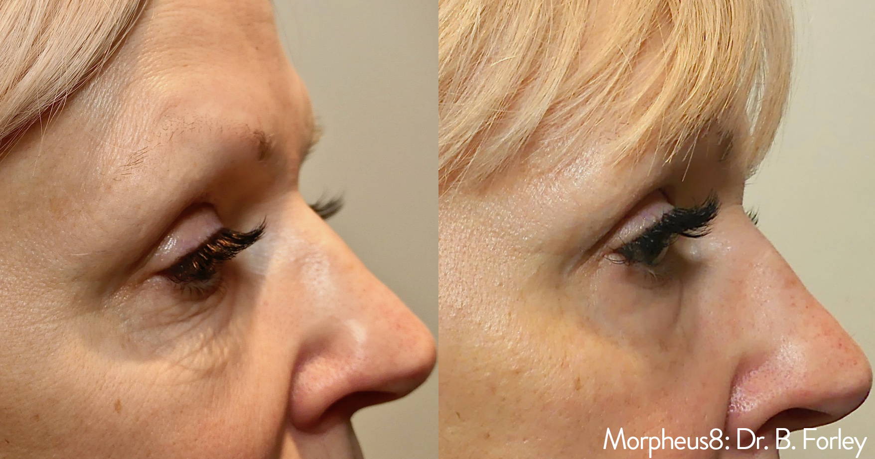 Manufacturer-published before and after Morpheus8 result shown in profile