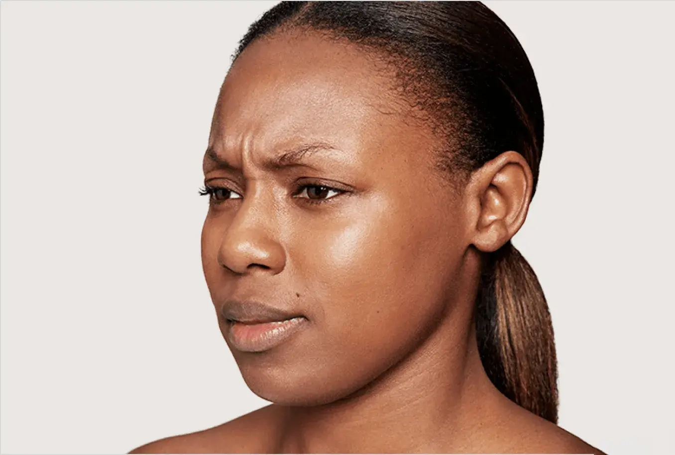 Salimah before and after Dysport treatment — before