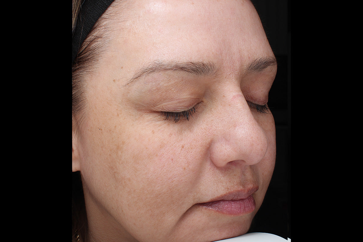 After VI Peel® manufacturer example