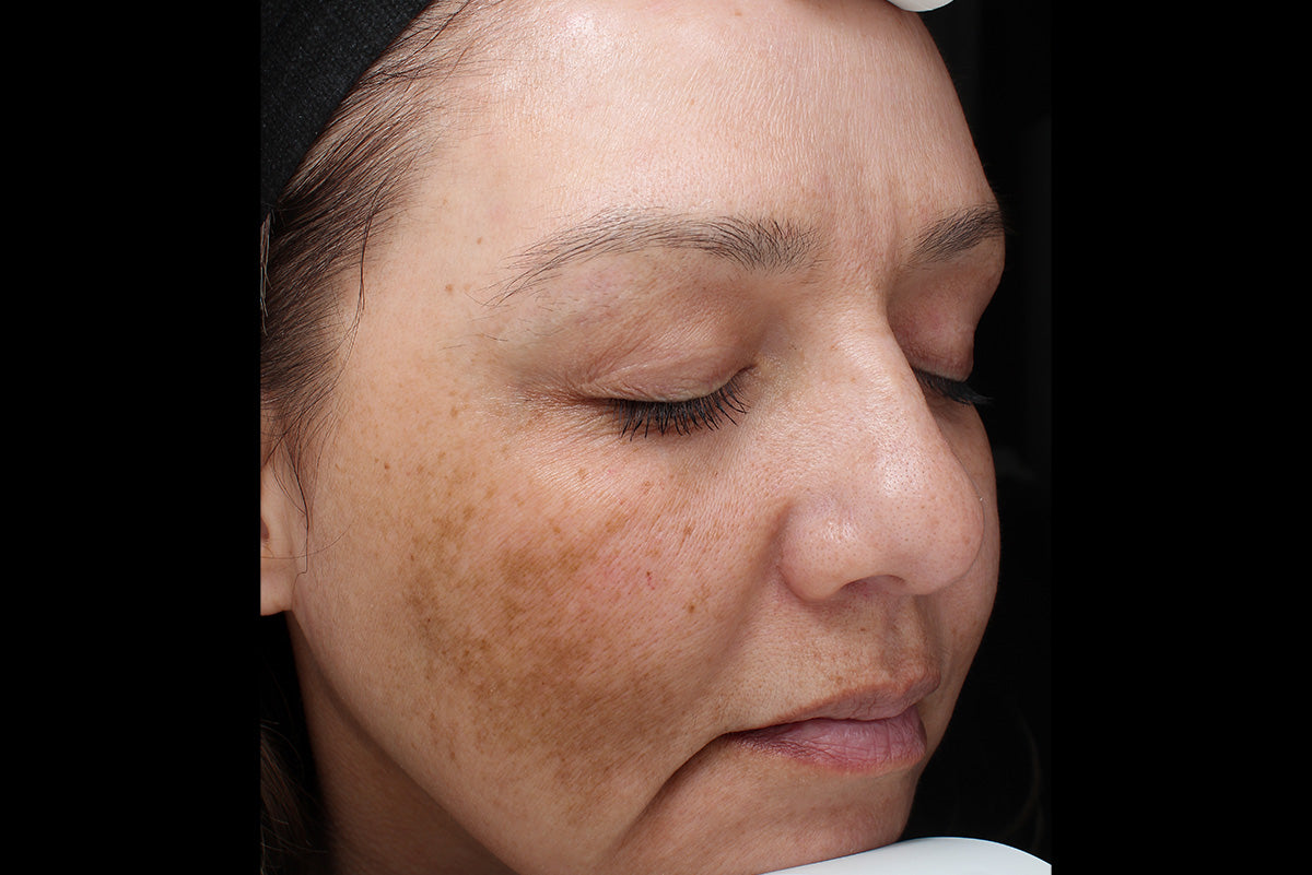 Before VI Peel® manufacturer example