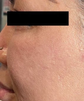 Close view of cheek texture before and after five PRX treatments — before