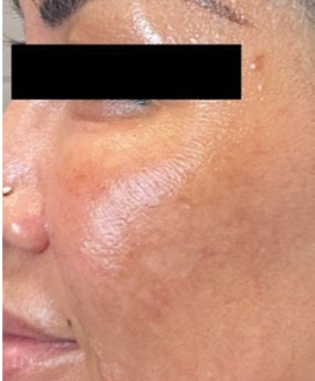 Close view of cheek texture before and after five PRX treatments — after