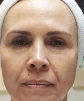Full-face view before and after four PRX treatments — before