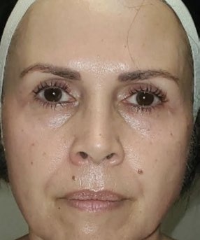 Full-face view before and after four PRX treatments — after