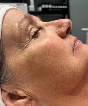 Profile view before and after four PRX treatments — before