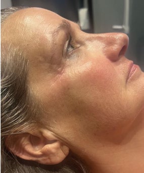 Profile view before and after four PRX treatments — after