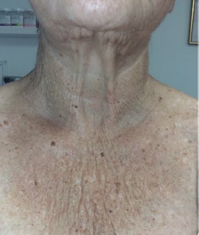 Neck and decolletage before and after one PRX treatment — before