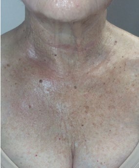 Neck and decolletage before and after one PRX treatment — after