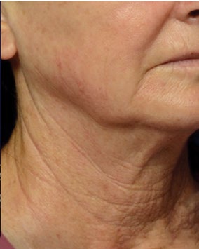 Lower face and neck before and after PRX treatment — before