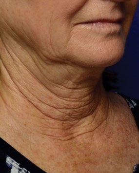 Lower face and neck before and after PRX treatment — after