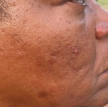 Cheek tone and texture before and after PRX treatment — before