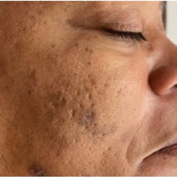 Cheek tone and texture before and after PRX treatment — after